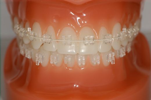 Beyaz Diş Teli Dişleri Düzeltir mi?