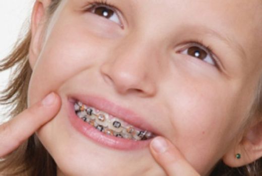 Diş Teli Ağız Yarası Belirtileri ve Tedavisi