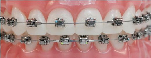 Diş Teli Aşamaları Nelerdir?