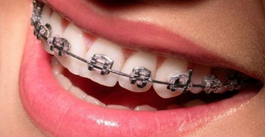Diş Teli Braket Çıkması