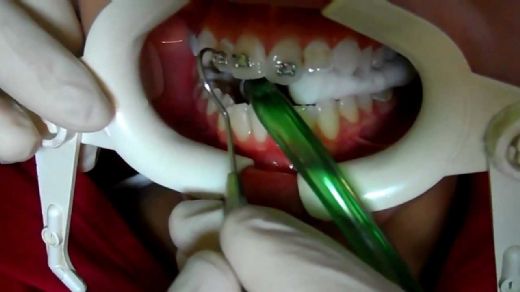 Diş Teli Çıkarma Diş Teli Nasıl Çıkartılır
