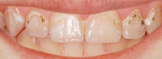 Diş Teli Çıktıktan Sonra Leke