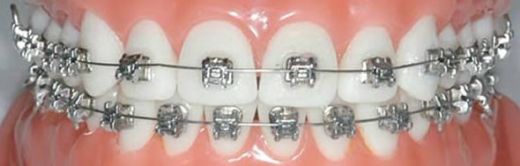 Diş Teli Malzemeleri Nelerdir?