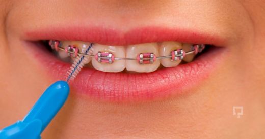 Diş Teli Temizliği Nasıl Yapılmalıdır?