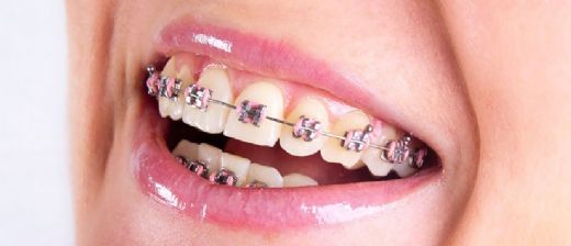 Diş Teli Yemek Listesi