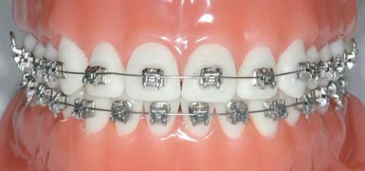 Ortodonti Diş Teli Etkilleri